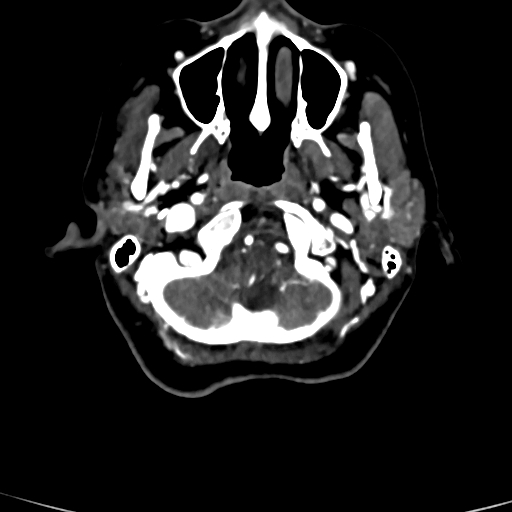 Cerebral arteriovenous malformation (Radiopaedia 73830-84645 Axial C+ delayed 87).jpg