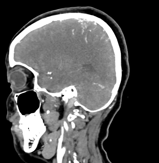 Cerebral arteriovenous malformation (Radiopaedia 73830-84645 D 65).jpg