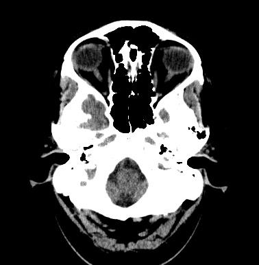 File:Cerebral arteriovenous malformation (Radiopaedia 74411-85744 Axial non-contrast 3).jpg