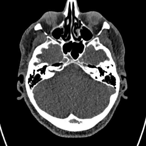 Cerebral arteriovenous malformation (Radiopaedia 78188-90746 Axial non-contrast 43).jpg