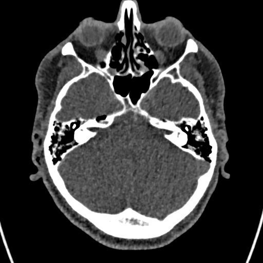 Cerebral arteriovenous malformation (Radiopaedia 78188-90746 Axial non-contrast 47).jpg