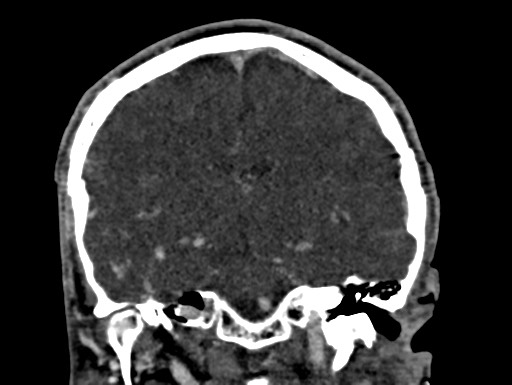Cerebral arteriovenous malformation (Radiopaedia 78188-90746 Coronal C+ delayed 61).jpg