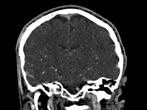 File:Cerebral arteriovenous malformation (Radiopaedia 78188-90746 Coronal C+ delayed 64).jpg