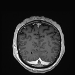 Cerebral arteriovenous malformation (Radiopaedia 84015-99245 Coronal T1 C+ 137).jpg