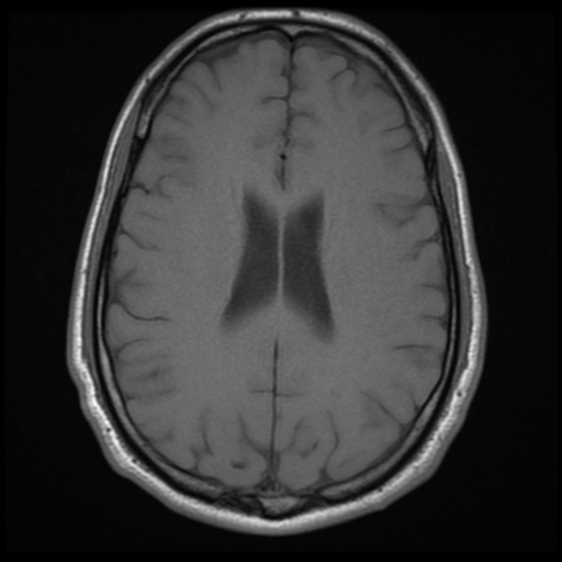 File:Cerebral arteriovenous malformation (Spetzler-Martin grade 2) (Radiopaedia 41262-44092 Axial T1 13).png