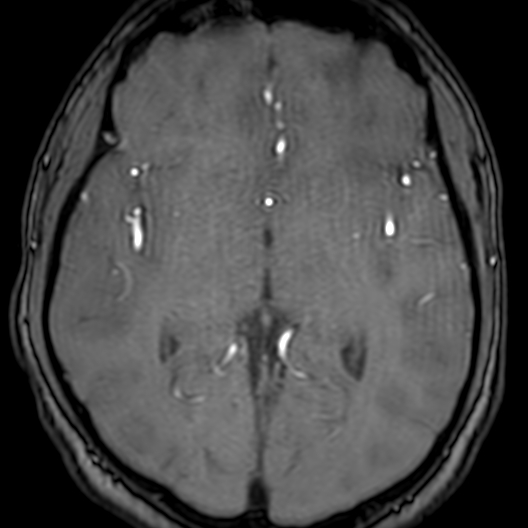 Cerebral arteriovenous malformation at posterior body of corpus callosum (Radiopaedia 74111-84925 Axial MRA 102).jpg