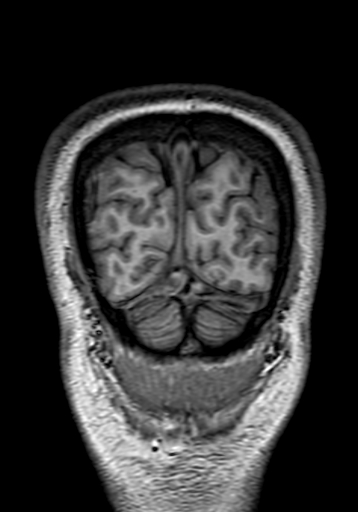 Cerebral arteriovenous malformation at posterior body of corpus callosum (Radiopaedia 74111-84925 Coronal T1 324).jpg