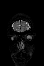 Cerebral arteriovenous malformation at posterior body of corpus callosum (Radiopaedia 74111-84925 Coronal T2 5).jpg