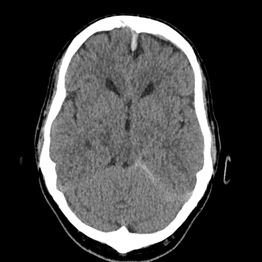 Cerebral arteriovenous malformation with lobar hemorrhage (Radiopaedia 35598-37117 Axial non-contrast 20).jpg