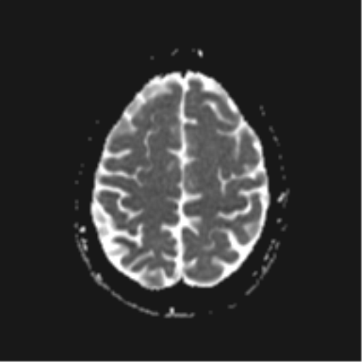 File:Cerebral cavernoma and development venous anomaly (Radiopaedia 37603-39482 Axial ADC 18).png