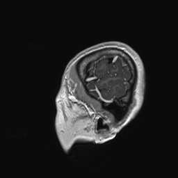 Cerebral cavernous venous malformation (Radiopaedia 70008-80021 Sagittal T1 C+ 5).jpg