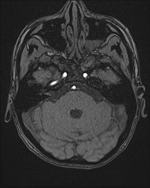 File:Cerebral embolic infarcts (embolic shower) (Radiopaedia 72391-82921 Axial MRA 29).jpg