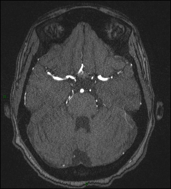 Cerebral fat embolism (Radiopaedia 35022-36525 Axial TOF 65).jpg
