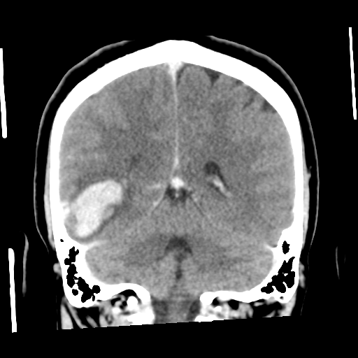 Cerebral hemorrhage secondary to arteriovenous malformation (Radiopaedia 33497-34561 C 45).png