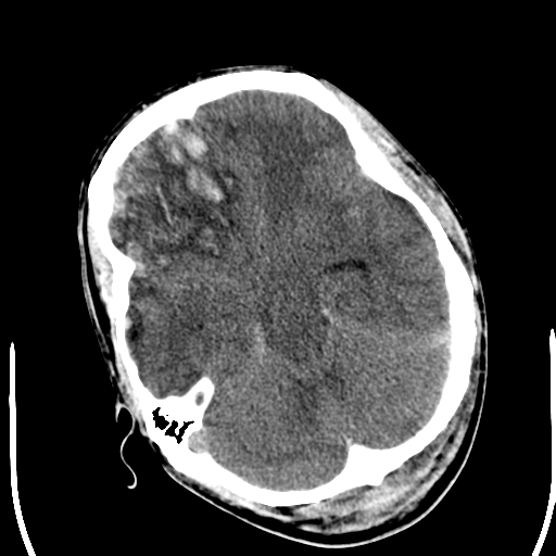 File:Cerebral hemorrhagic contusions- temporal evolution (Radiopaedia 40224-42752 Axial non-contrast 9).png
