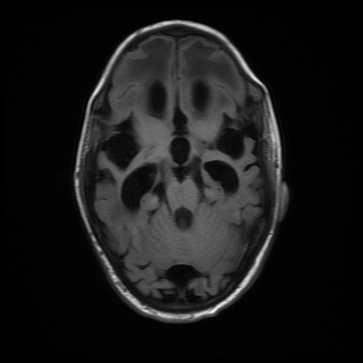 File:Cerebral manifestations of mucopolysaccharidosis type I (Radiopaedia 59171-66487 C 7).jpg