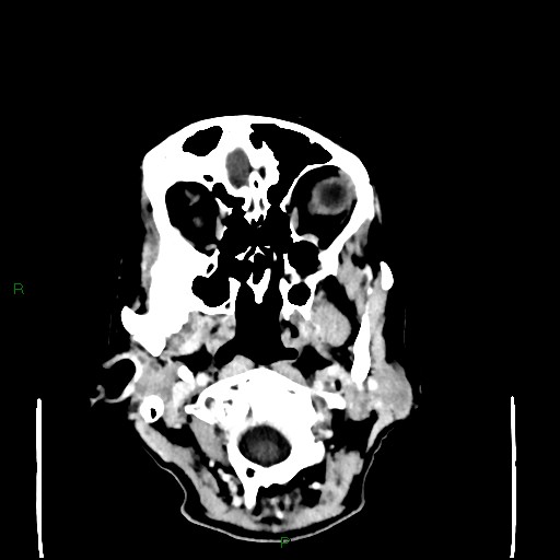 Cerebral metastases - breast primary (Radiopaedia 77653-89857 Axial C+ delayed 11).jpg