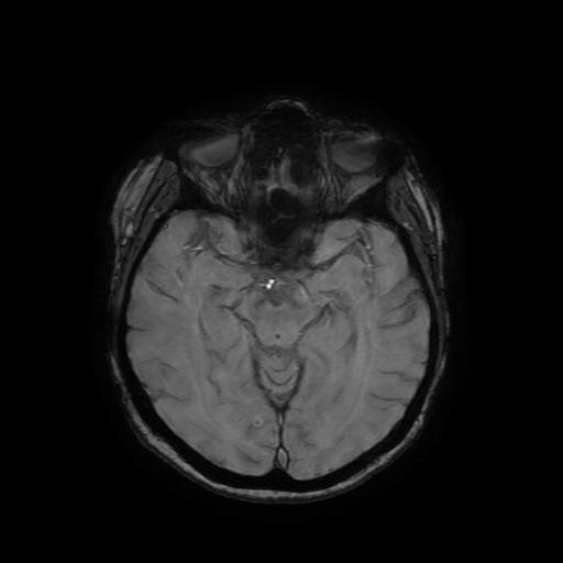 Cerebral metastases - melanoma (Radiopaedia 80972-94522 Axial SWI 42).jpg