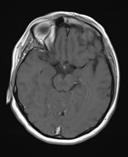 File:Cerebral metastases mimicking abscesses (Radiopaedia 45841-50131 Axial T1 C+ fat sat 12).png