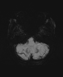 File:Cerebral metastasis (Radiopaedia 46744-51248 Axial SWI 6).png
