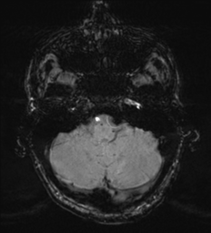 File:Cerebral metastasis - melanoma (Radiopaedia 54718-60954 Axial SWI 11).png