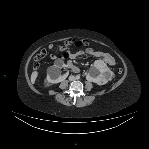 Cerebral metastasis from renal cell carcinoma (Radiopaedia 82306-96378 A 102).jpg