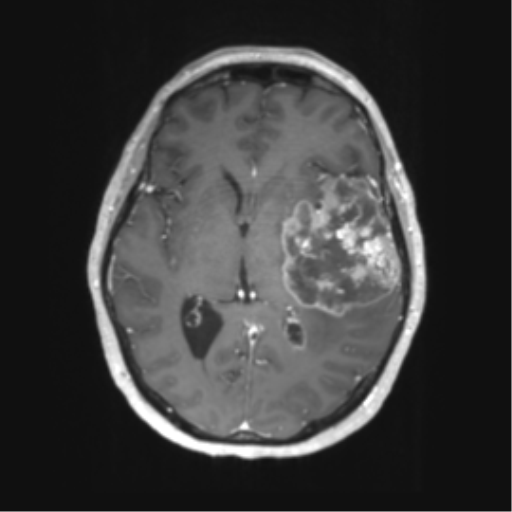 Cerebral metastasis mimicking glioblastoma (Radiopaedia 69155-78937 Axial T1 C+ 32).png