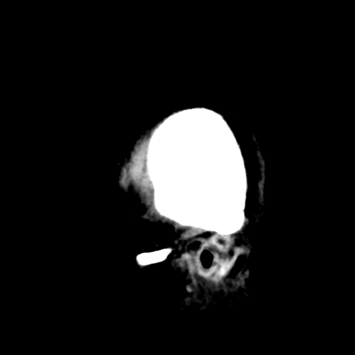 Cerebral metastasis to basal ganglia (Radiopaedia 81568-95412 E 54).png