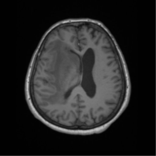 Cerebral metastasis to basal ganglia (Radiopaedia 81568-95413 Axial T1 46).png