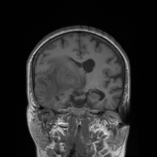 Cerebral metastasis to basal ganglia (Radiopaedia 81568-95413 Coronal T1 28).png