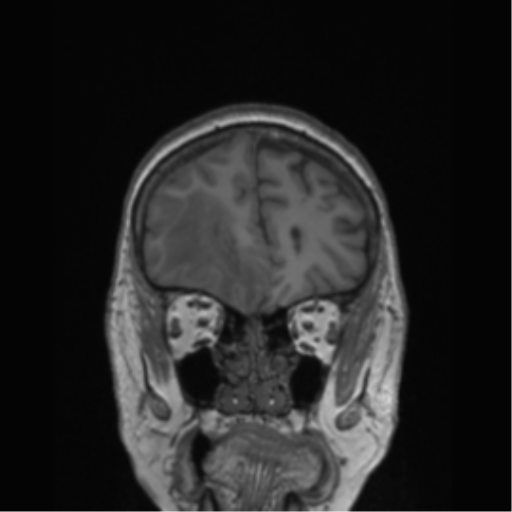 Cerebral metastasis to basal ganglia (Radiopaedia 81568-95413 Coronal T1 50).png
