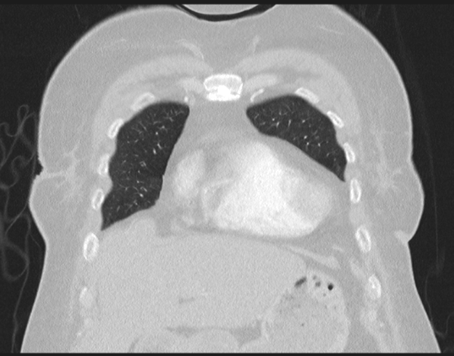 Cerebral metastasis to basal ganglia (Radiopaedia 81568-95414 Coronal lung window 22).png