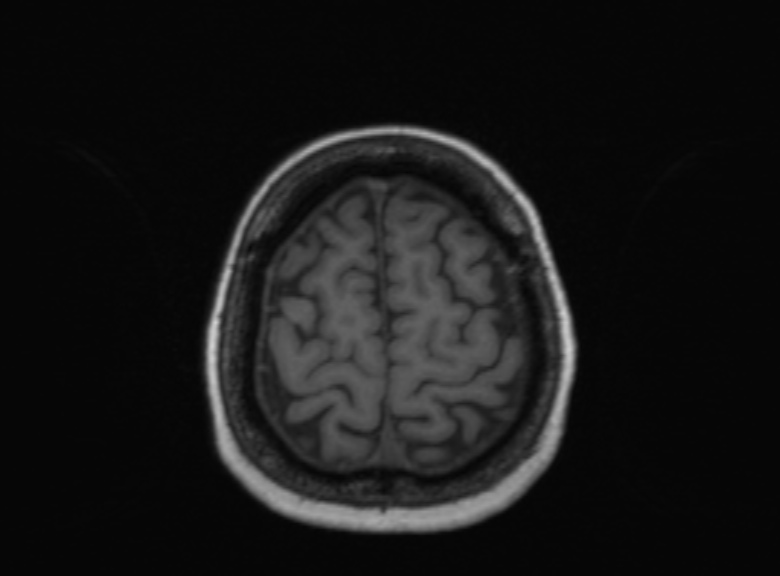 Cerebral ring enhancing lesions - cerebral metastases (Radiopaedia 44922-48817 Axial T1 129).jpg