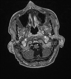 File:Cerebral toxoplasmosis (Radiopaedia 43956-47461 Axial T1 C+ 1).jpg