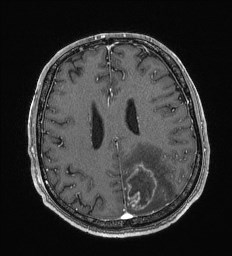 Cerebral toxoplasmosis (Radiopaedia 43956-47461 Axial T1 C+ 51).jpg