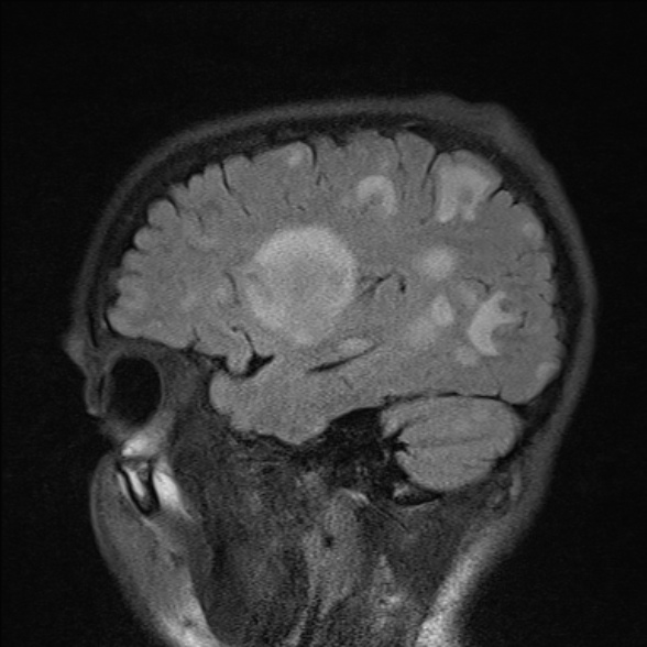File:Cerebral toxoplasmosis (Radiopaedia 53993-60132 Sagittal FLAIR 21).jpg