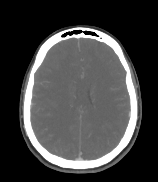 File:Cerebral venous hemorrhagic infarction (Radiopaedia 38461-40550 Axial MIP VENOGRAM 34).png