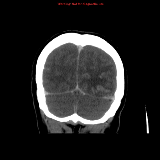 Cerebral venous infarction (Radiopaedia 12404-20735 B 70).jpg