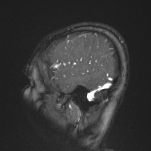 Cerebral venous infarction - hemorrhagic (Radiopaedia 81625-95505 Sagittal MRV 13).jpg