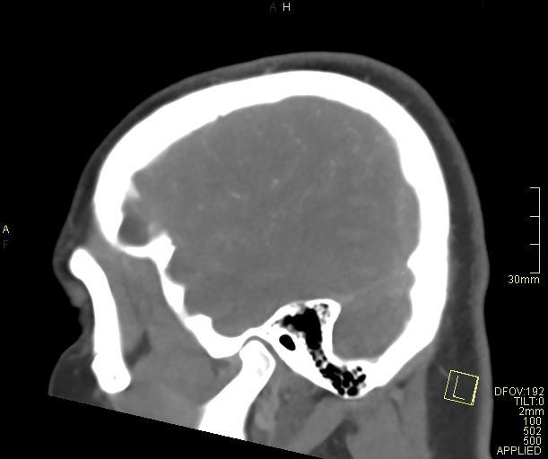 Cerebral venous sinus thrombosis (Radiopaedia 91329-108965 Sagittal venogram 63).jpg
