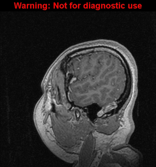File:Cerebral venous thrombosis (Radiopaedia 37224-39208 Sagittal T1 C+ 131).jpg