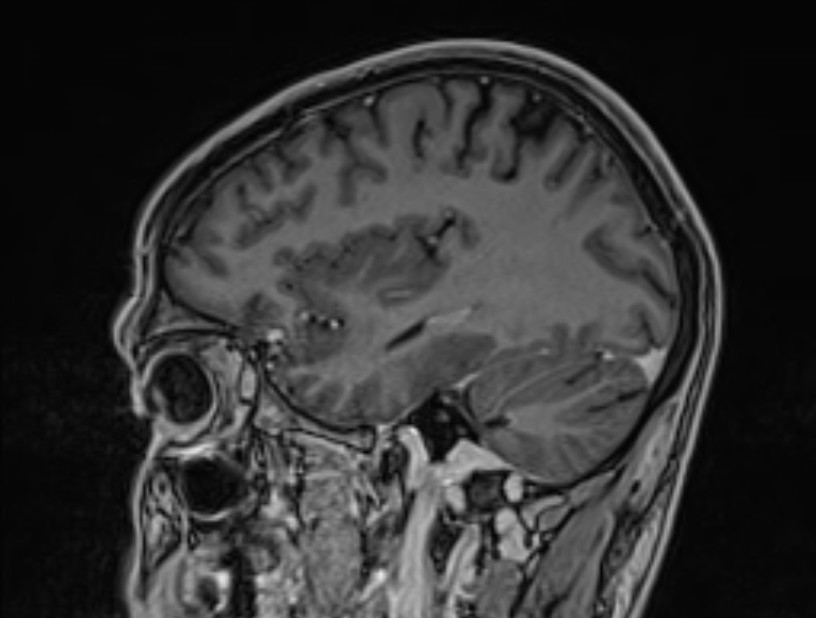 Cerebral venous thrombosis (Radiopaedia 71207-81504 Sagittal T1 C+ 15).jpg
