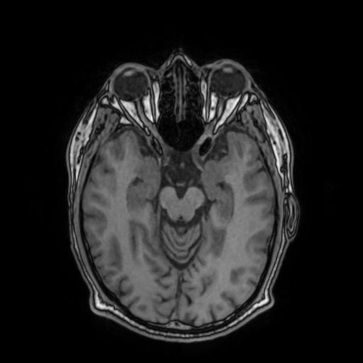 Cerebral venous thrombosis with secondary intracranial hypertension (Radiopaedia 89842-106957 Axial T1 78).jpg