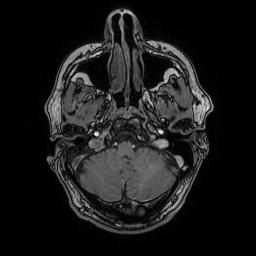 File:Cerebral venous thrombosis with secondary intracranial hypertension (Radiopaedia 89842-106957 Axial T1 C+ 46).jpg