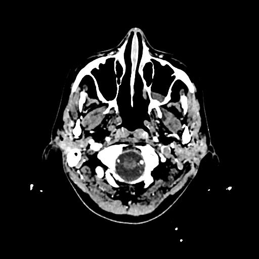 Cerebral venous thrombosis with venous hemorrhagic infarct (Radiopaedia 90354-107660 Axial with contrast 12).jpg