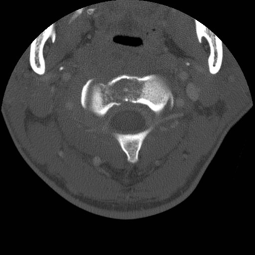 Cervical Pott disease (Radiopaedia 20374-20286 Axial bone window 33).jpg