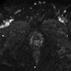 Cervical adenocarcinoma (Radiopaedia 65011-73985 Axial DWI 7).jpg