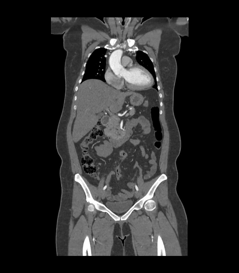 Cervical aortic arch with coarctation and aneurysms (Radiopaedia 44035-47552 C 30).jpg