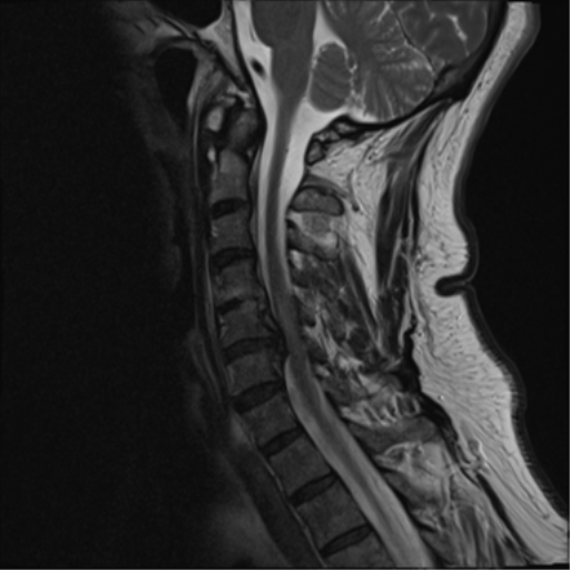 File:Cervical canal stenosis due to ossification of the posterior longitudinal ligament (Radiopaedia 47260-51824 Sagittal T2 6).png