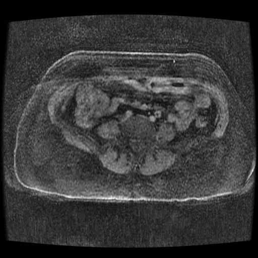 File:Cervical carcinoma (Radiopaedia 70924-81132 Axial T1 C+ fat sat 176).jpg